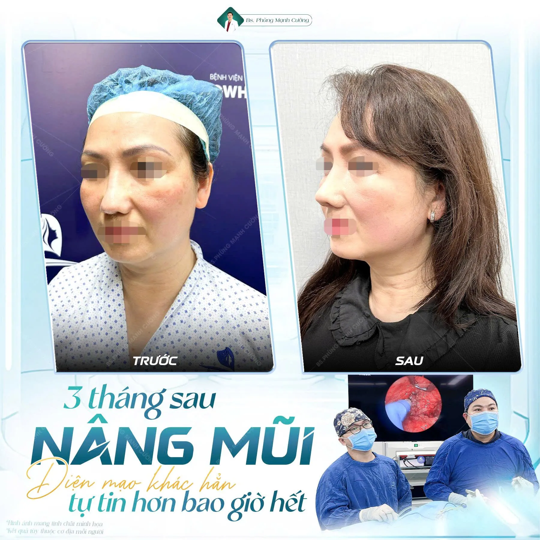 Nâng mũi S Line bọc sụn prosil: Những điều cần biết 11 nang mui s line prosil 2