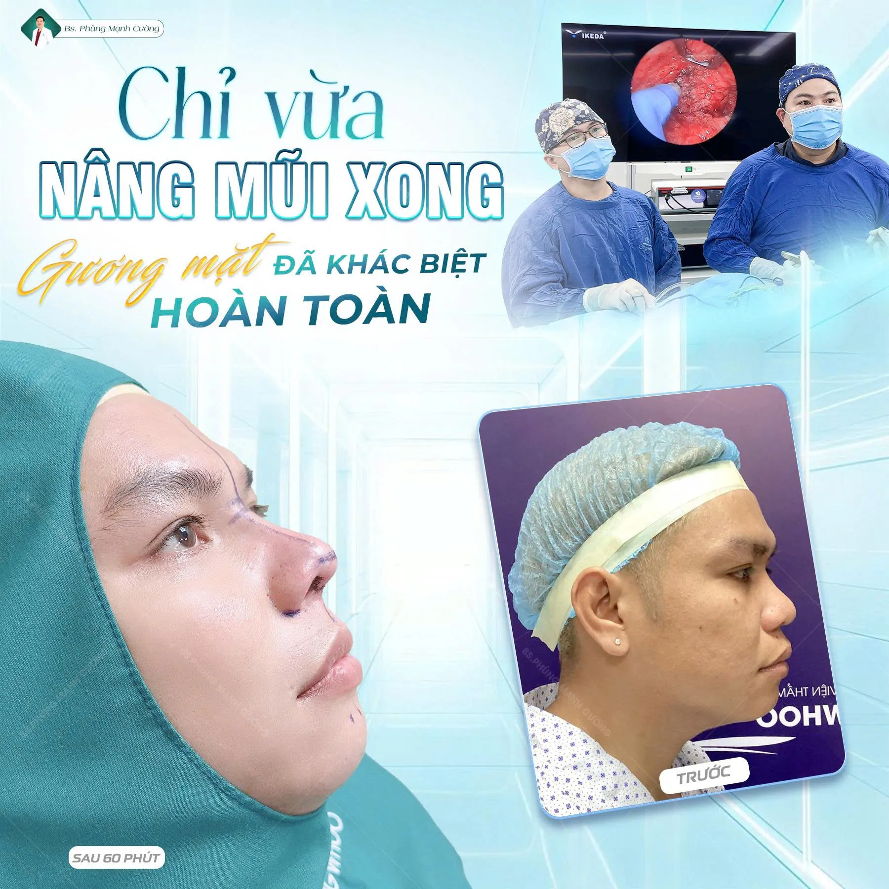 Nâng mũi S Line bọc sụn prosil: Những điều cần biết 10 nang mui s line prosil 3
