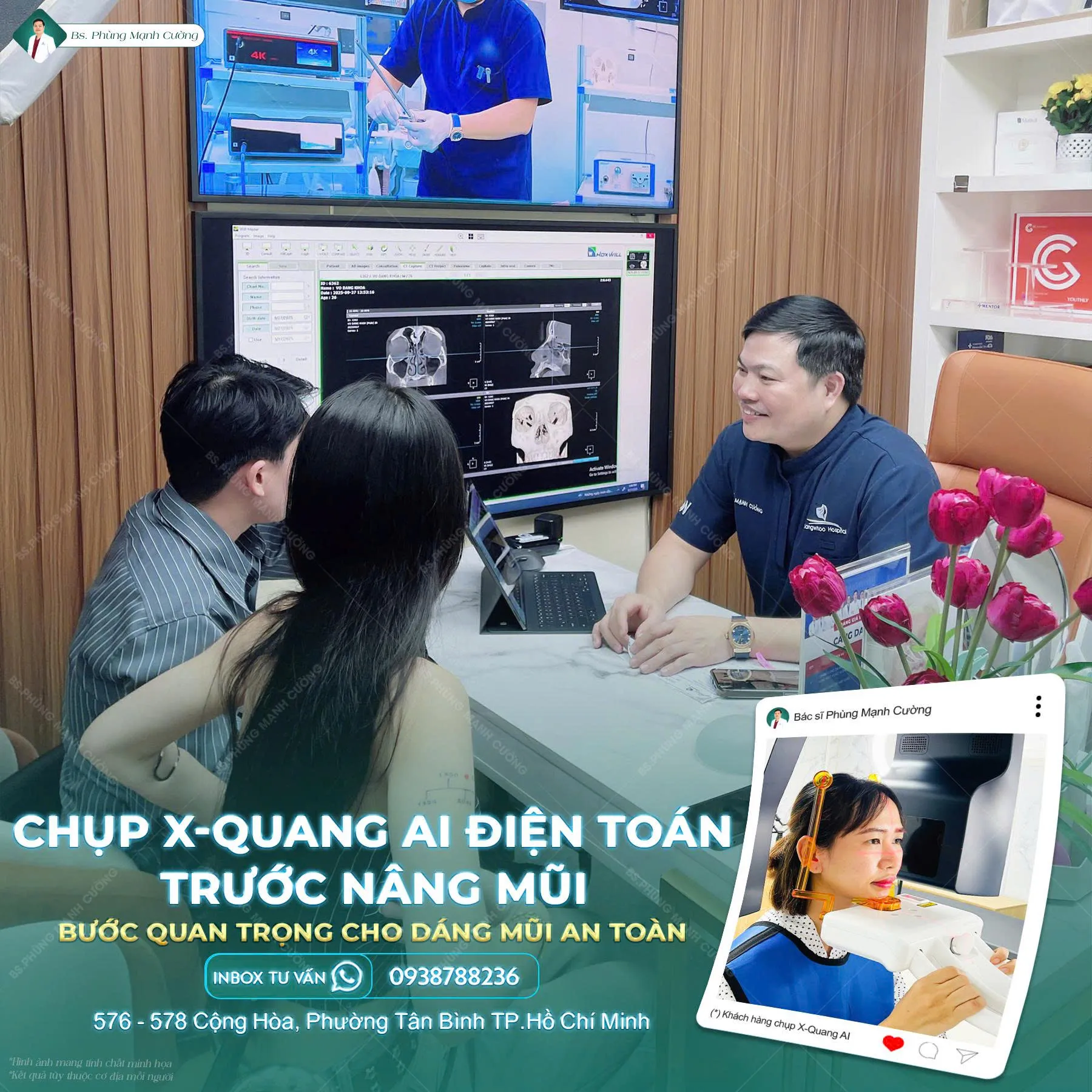 Nâng mũi S Line bọc sụn prosil: Những điều cần biết 9 nang mui s line prosil 5