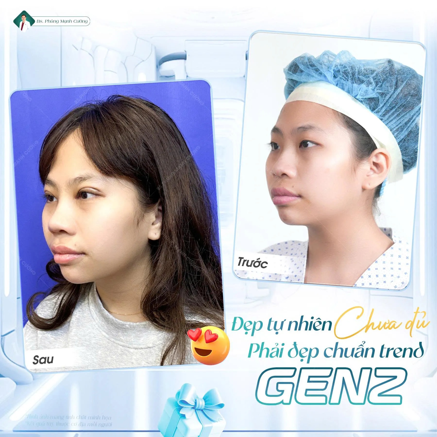 Nâng mũi S Line bọc sụn prosil: Những điều cần biết 7 Nâng mũi S Line bọc sụn prosil