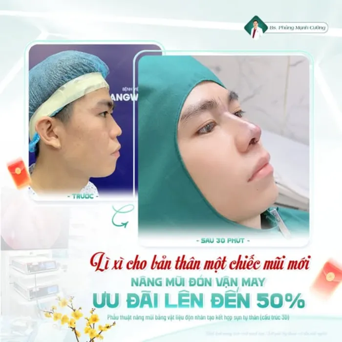 Nâng mũi ăn bánh bao được không? Cần lưu ý những gì?