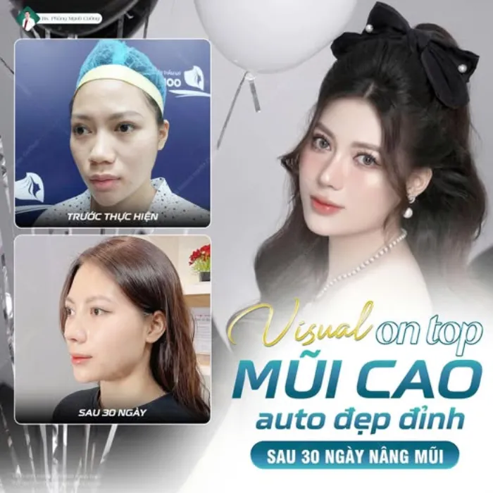 Nâng mũi ăn bánh bao được không? Cần lưu ý những gì?