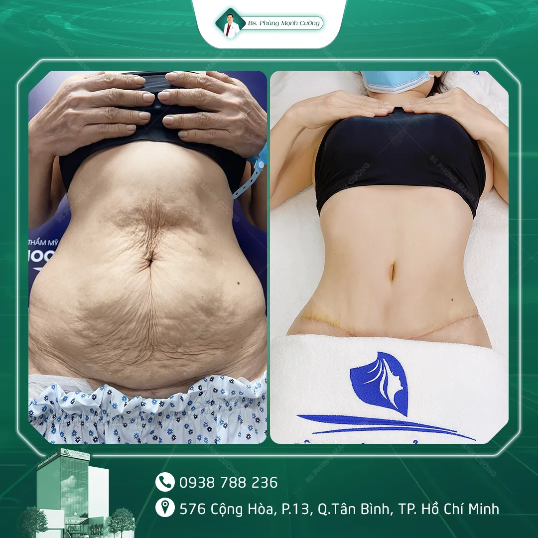 Hình Ảnh, Video Khách Hàng Căng Da Bụng Tại Bs Phùng Mạnh Cường