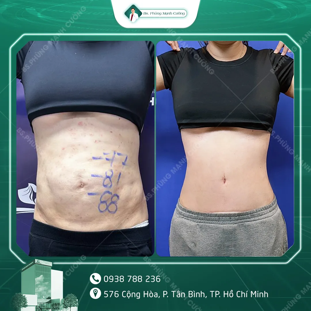Hình Ảnh, Video Khách Hàng Căng Da Bụng Tại Bs Phùng Mạnh Cường