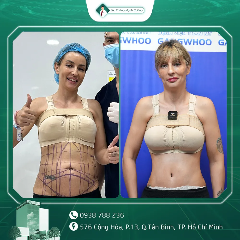 Hình Ảnh, Video Khách Hàng Căng Da Bụng Tại Bs Phùng Mạnh Cường