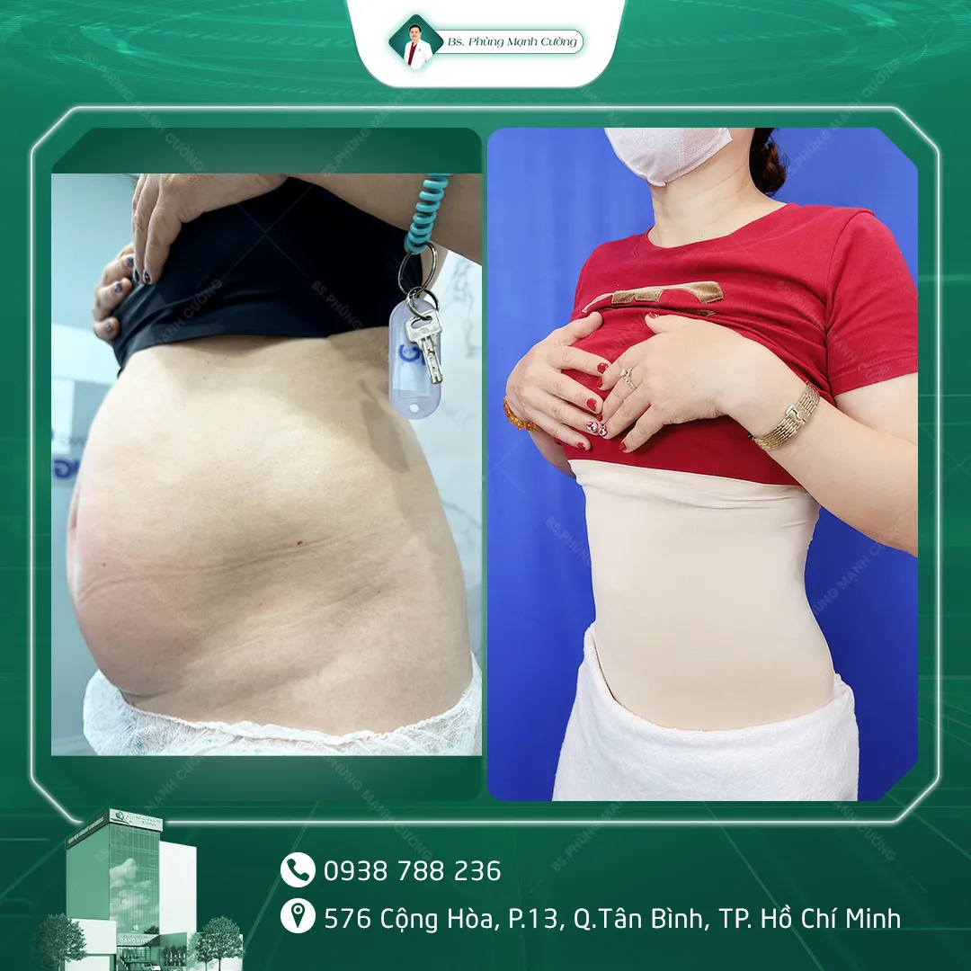 Hình Ảnh, Video Khách Hàng Căng Da Bụng Tại Bs Phùng Mạnh Cường