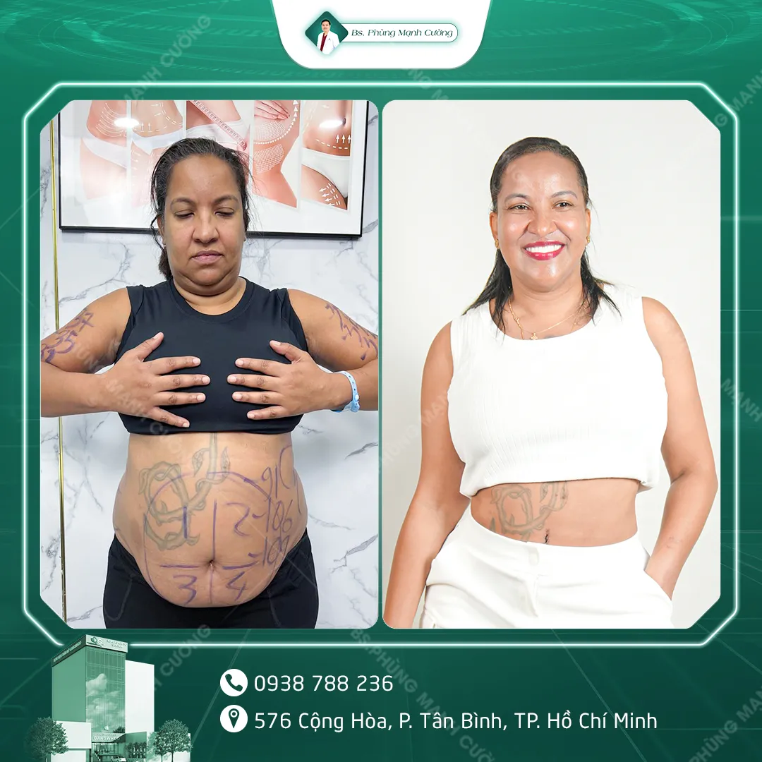 Hình Ảnh, Video Khách Hàng Căng Da Bụng Tại Bs Phùng Mạnh Cường