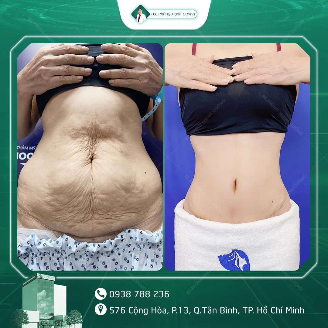 Hình Ảnh, Video Khách Hàng Căng Da Bụng Tại Bs Phùng Mạnh Cường