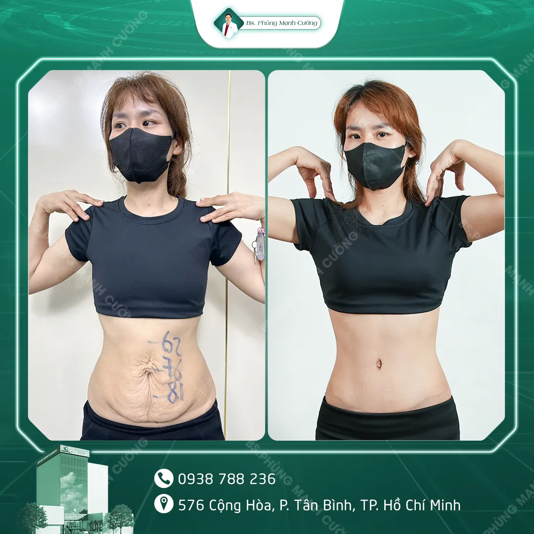 Hình Ảnh, Video Khách Hàng Căng Da Bụng Tại Bs Phùng Mạnh Cường