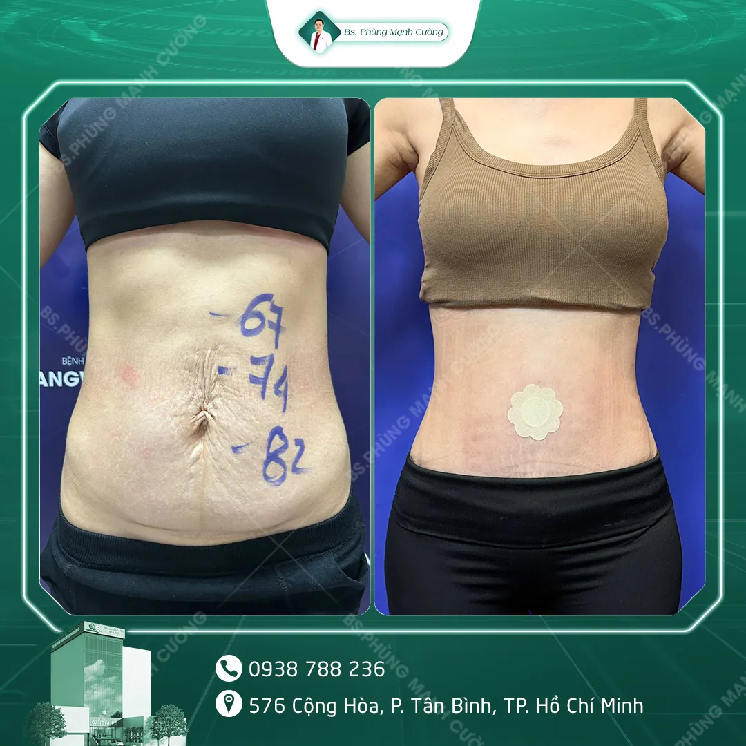 Hình Ảnh, Video Khách Hàng Căng Da Bụng Tại Bs Phùng Mạnh Cường