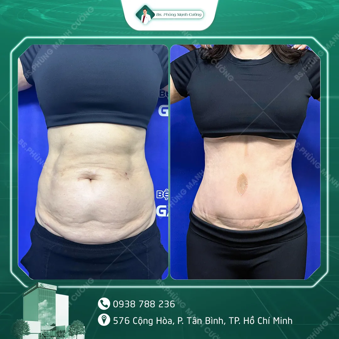 Hình Ảnh, Video Khách Hàng Căng Da Bụng Tại Bs Phùng Mạnh Cường