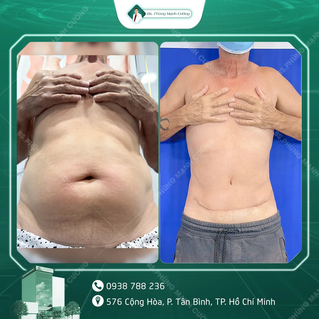 Hình Ảnh, Video Khách Hàng Căng Da Bụng Tại Bs Phùng Mạnh Cường