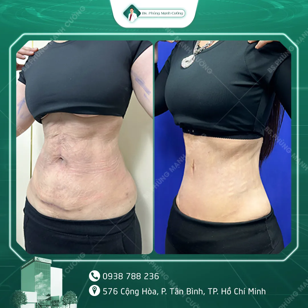 Hình Ảnh, Video Khách Hàng Căng Da Bụng Tại Bs Phùng Mạnh Cường