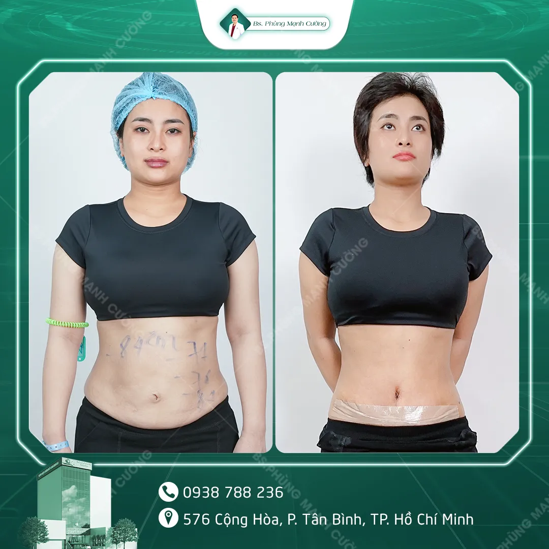 Hình Ảnh, Video Khách Hàng Căng Da Bụng Tại Bs Phùng Mạnh Cường