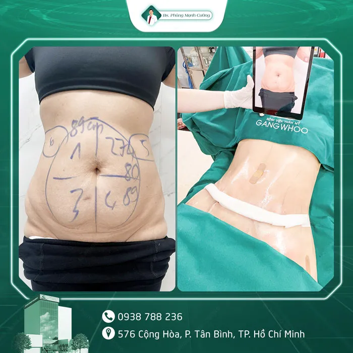 Hình Ảnh, Video Khách Hàng Căng Da Bụng Tại Bs Phùng Mạnh Cường