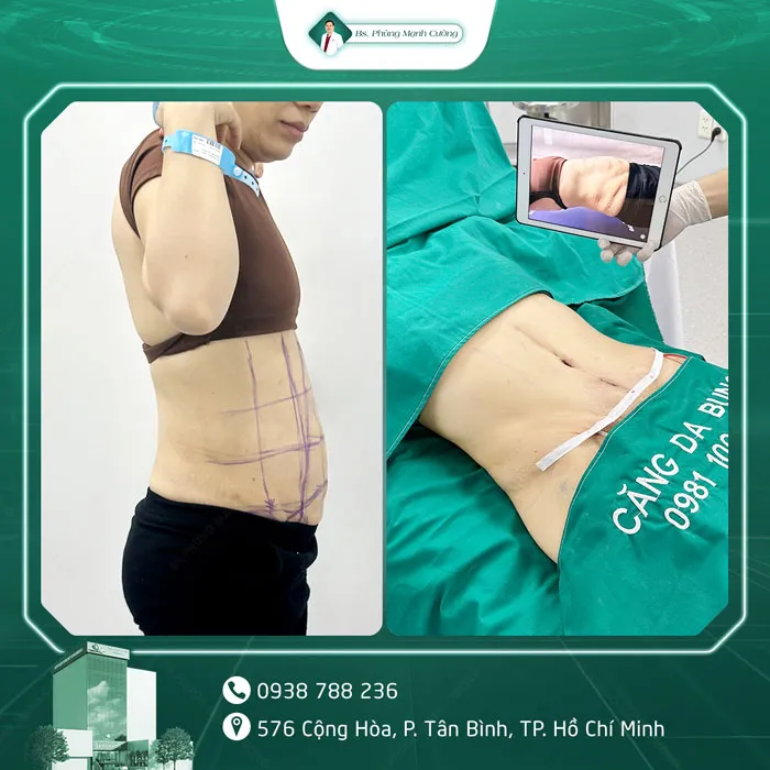 Hình Ảnh, Video Khách Hàng Căng Da Bụng Tại Bs Phùng Mạnh Cường