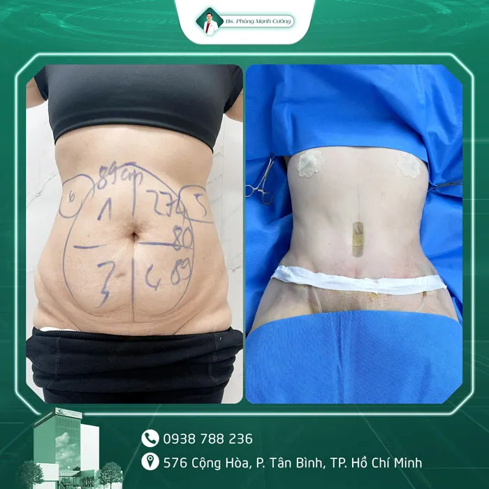 Hình Ảnh, Video Khách Hàng Căng Da Bụng Tại Bs Phùng Mạnh Cường