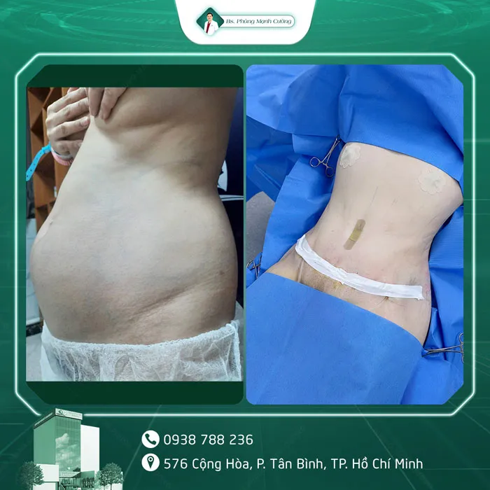 Hình Ảnh, Video Khách Hàng Căng Da Bụng Tại Bs Phùng Mạnh Cường