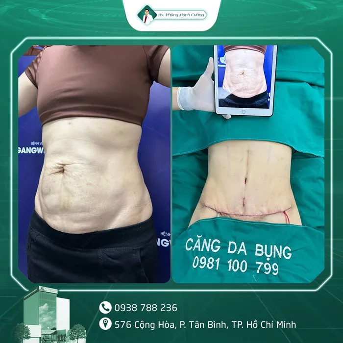 Hình Ảnh, Video Khách Hàng Căng Da Bụng Tại Bs Phùng Mạnh Cường