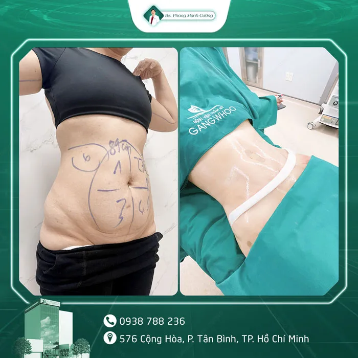 Hình Ảnh, Video Khách Hàng Căng Da Bụng Tại Bs Phùng Mạnh Cường