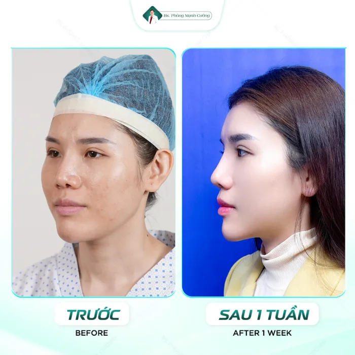 Hình ảnh khách hàng sau 1 tuần, dáng mũi dần ổn định, hài hòa và trông tự nhiên hơn theo thời gian