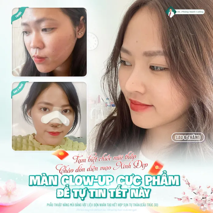 Các yếu tố ảnh hưởng sau nâng mũi