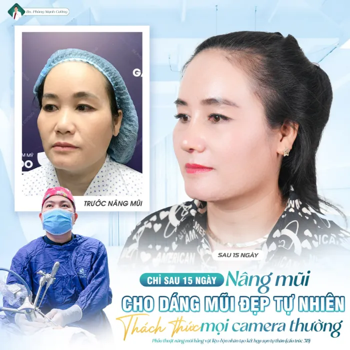 Địa chỉ nâng mũi uy tín, an toàn và chất lượng