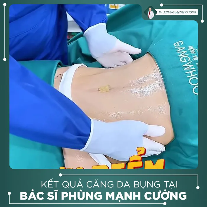 Hình Ảnh, Video Khách Hàng Căng Da Bụng Tại Bs Phùng Mạnh Cường