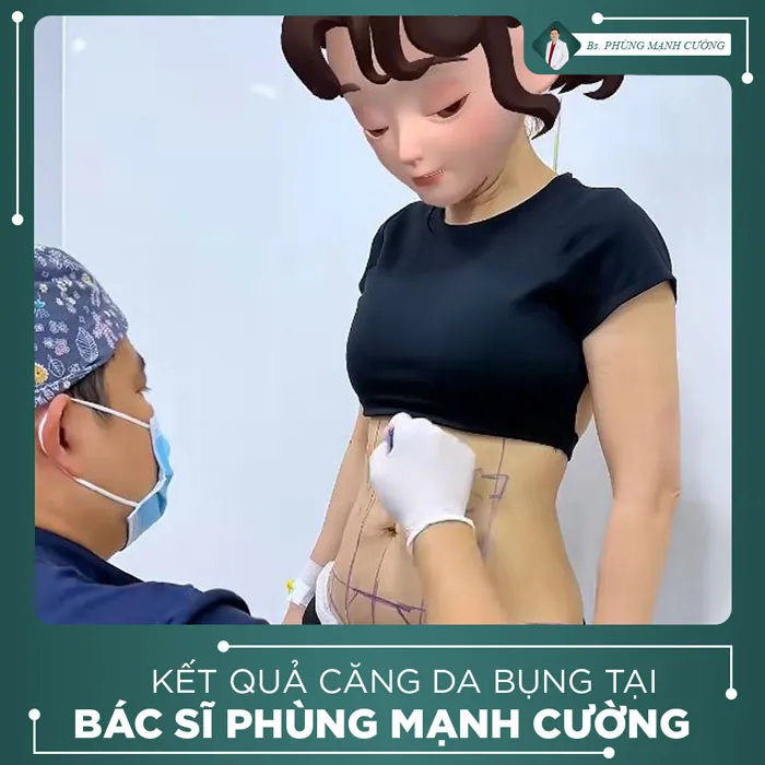 Hình Ảnh, Video Khách Hàng Căng Da Bụng Tại Bs Phùng Mạnh Cường
