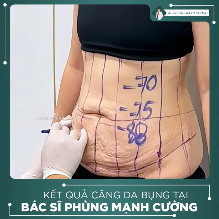 Hình Ảnh, Video Khách Hàng Căng Da Bụng Tại Bs Phùng Mạnh Cường