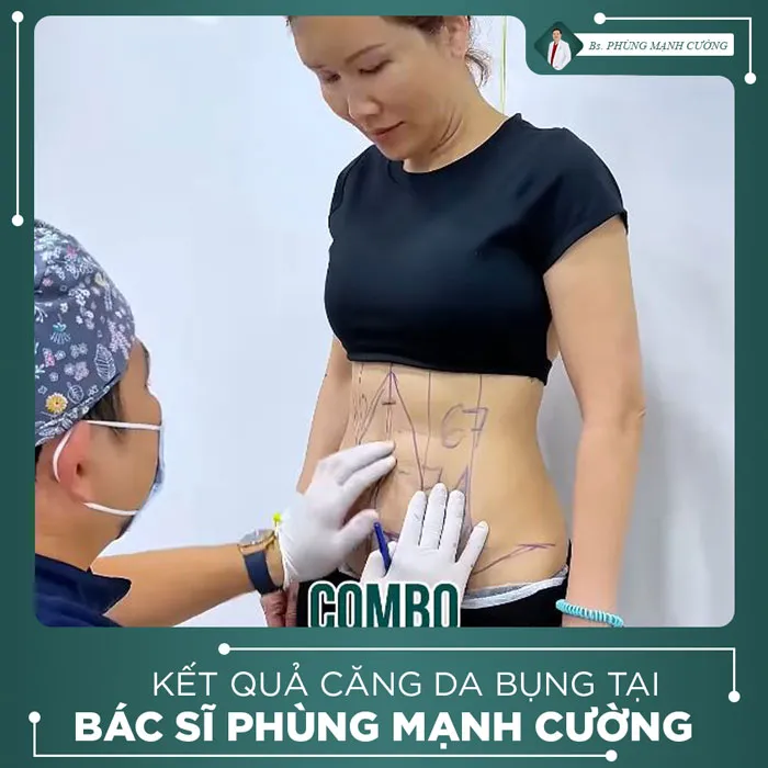 Hình Ảnh, Video Khách Hàng Căng Da Bụng Tại Bs Phùng Mạnh Cường