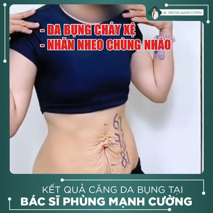 Hình Ảnh, Video Khách Hàng Căng Da Bụng Tại Bs Phùng Mạnh Cường