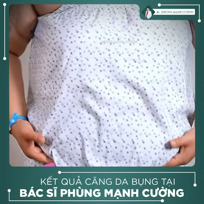 Hình Ảnh, Video Khách Hàng Căng Da Bụng Tại Bs Phùng Mạnh Cường