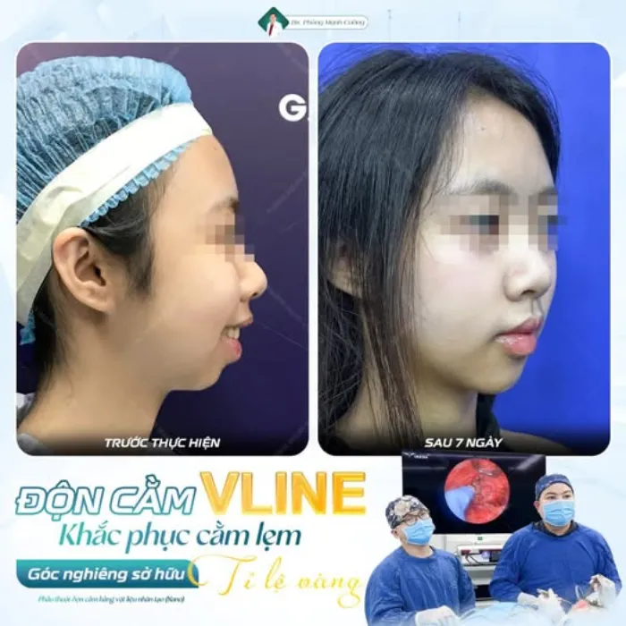 Các phương pháp độn cằm giúp giảm hô hiệu quả