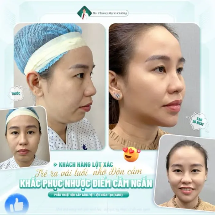 Độn cằm giúp cải thiện hô nhẹ, tạo khuôn mặt cân đối và hài hòa hơn