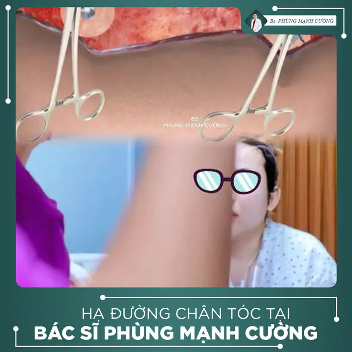 Video Khách Hàng Hạ Đường Chân Tóc Tại Bs Phùng Mạnh Cường