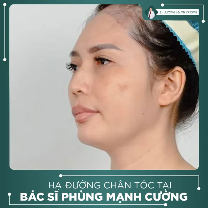 Video Khách Hàng Hạ Đường Chân Tóc Tại Bs Phùng Mạnh Cường