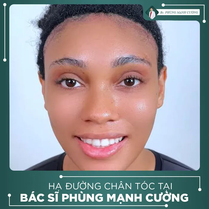 Video Khách Hàng Hạ Đường Chân Tóc Tại Bs Phùng Mạnh Cường