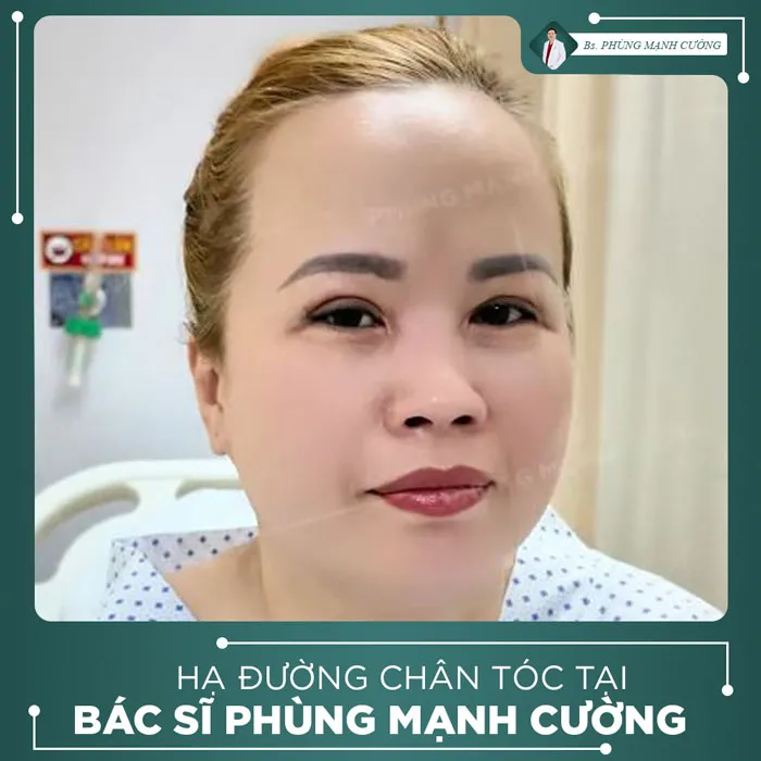 Video Khách Hàng Hạ Đường Chân Tóc Tại Bs Phùng Mạnh Cường