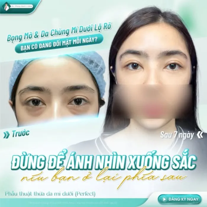 Cắt mí dưới có để lại sẹo không? Kết quả cho thấy mí dưới mịn màng, khó nhận thấy dấu vết