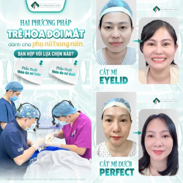 Cắt mí dưới có để lại sẹo không? Hình ảnh trước – sau cho thấy mí dưới phục hồi tự nhiên, không lộ sẹo