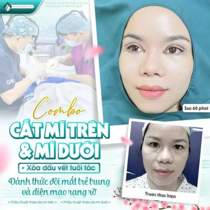 Cắt mí dưới có để lại sẹo không? Giải đáp chi tiết từ bác sĩ thẩm mỹ