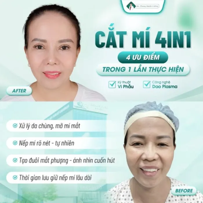 Người lớn tuổi có nên cắt mí mắt không? Những yếu tố cần cân nhắc trước khi cắt mí 9 Người lớn tuổi có nên cắt mí mắt không? Những yếu tố cần cân nhắc trước khi cắt mí