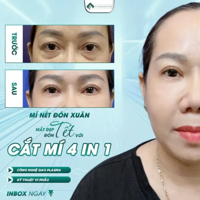 Người lớn tuổi có nên cắt mí mắt không? Những yếu tố cần cân nhắc trước khi cắt mí 11 Người lớn tuổi có nên cắt mí mắt không? Những yếu tố cần cân nhắc trước khi cắt mí