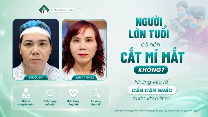 Người lớn tuổi có nên cắt mí mắt không? Những yếu tố cần cân nhắc trước khi cắt mí