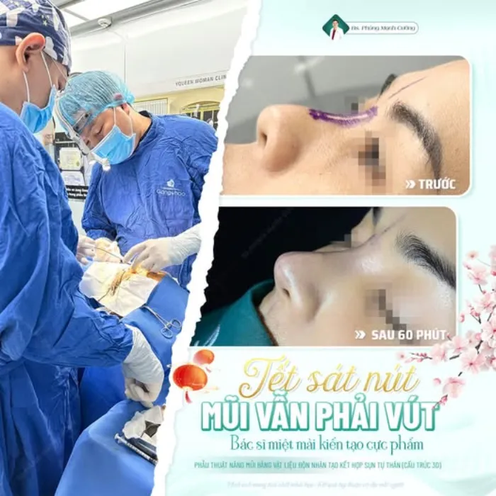 Nâng mũi bị ngứa: Nguyên nhân và cách xử lý 5 Nâng mũi bị ngứa: Nguyên nhân và cách xử lý