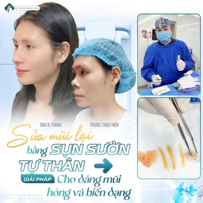 Kết quả sau sửa mũi hỏng bằng sụn sườn: dáng mũi ổn định, cân đối, khắc phục khuyết điểm và tự nhiên hơn