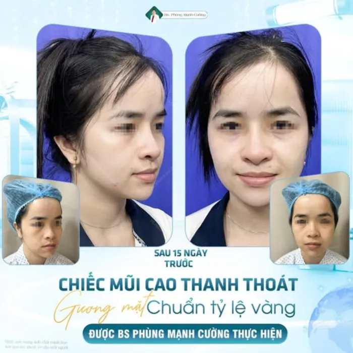 Nâng mũi vĩnh viễn giá bao nhiêu? Giá mới nhất hiện nay