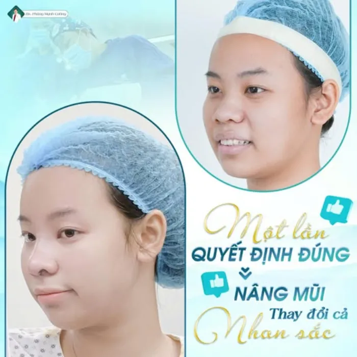 Nâng mũi vĩnh viễn giá bao nhiêu? Giá mới nhất hiện nay