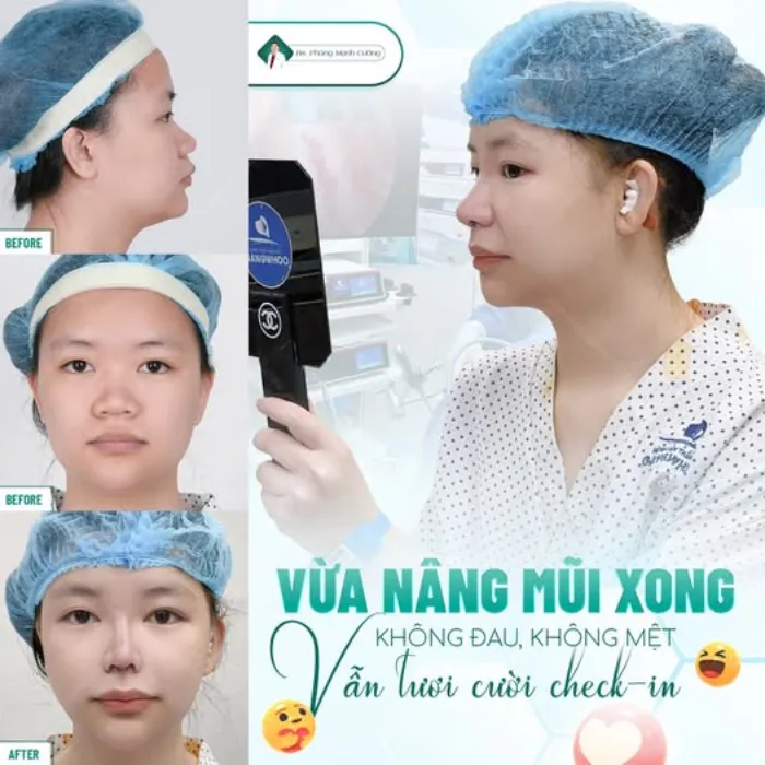 Nâng mũi xong có thể thu nhỏ đầu mũi không 6 Nâng mũi xong có thể thu nhỏ đầu mũi không